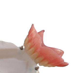 High Biocompatibility Precision Attachment Denture CAD-CAM Implant