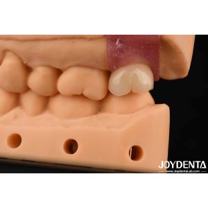 Cheap 4.1mm V Shaped Thread Titanium Abutments With Internal Hex Connection for sale