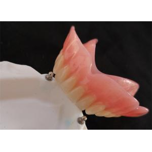 High Biocompatibility Precision Attachment Denture CAD-CAM Implant