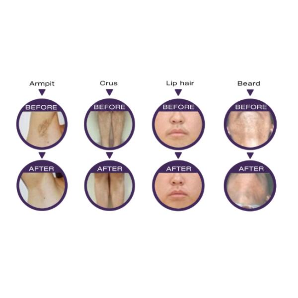 Permanent Diode Laser Hair Removal Machine