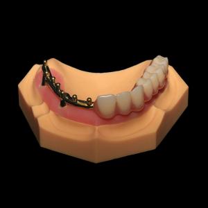 Class 3 Milled Titanium Bar All On X Dental Implants with Full Acrylic Denture
