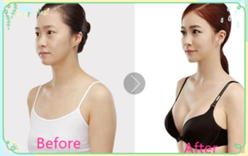 1.0ml Hyaluronic Acid Facial Filler , Injection Hyaluronic Acid Gel For Face