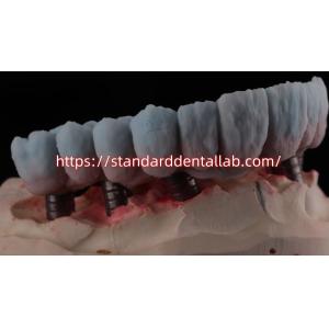 Implant Supported Zirconia Bridge With Titanium Abutment High Esthetics