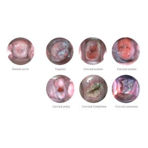 Portable Digital Electronic Colposcope