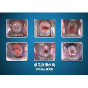 High Definition Display Digital Electronic Colposcope Portable Device to Check Cervix and Vagin