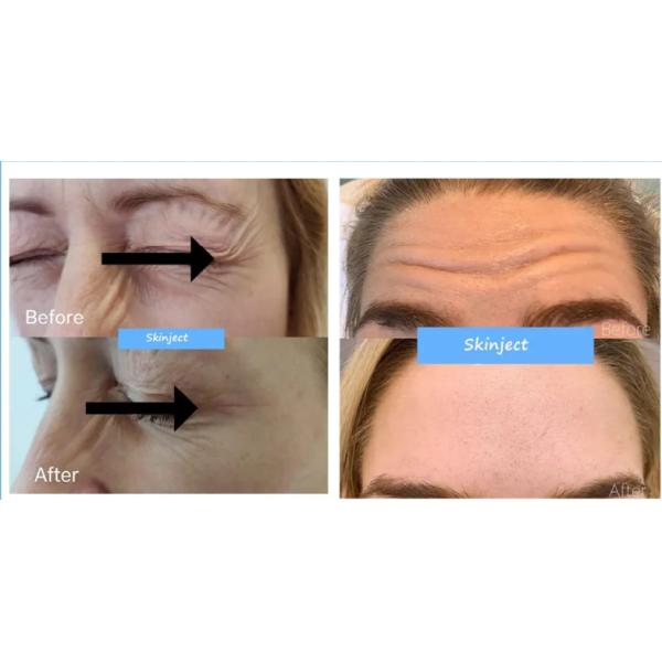 Korea Revolax 1.1ml Hyaluronic Acid Dermal Filler Injection Filler For Face