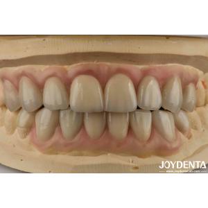Cheap High Translucency Emax Cosmetic Dentistry Veneers High Aesthetics Ultra Thin for sale