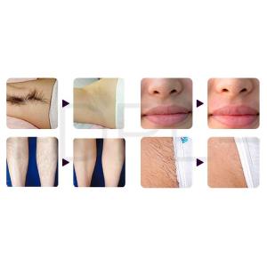 2022 New high power fixed 810nm diode to high quality laser rapid hair removal