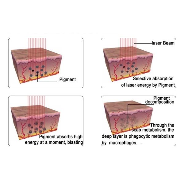Professional Q Switched Nd Yag Laser Tattoo Removal Machine For Skin Rejuvenation And Age Pigment Birthmark 6 Functions