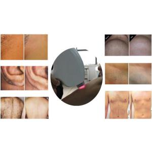 Laser Emitter Diode Laser Hair Removal Machine With 'In-Motion'