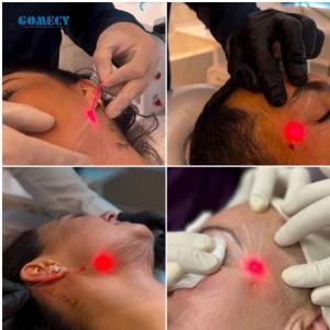 30W Endolift Laser Machine with Scanning Pattern Power 10 Inch LCD Touch Screen