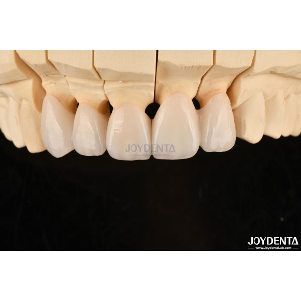 Highly Customizable Layered Zirconia Dental Crowns And Bridges Long Lasting