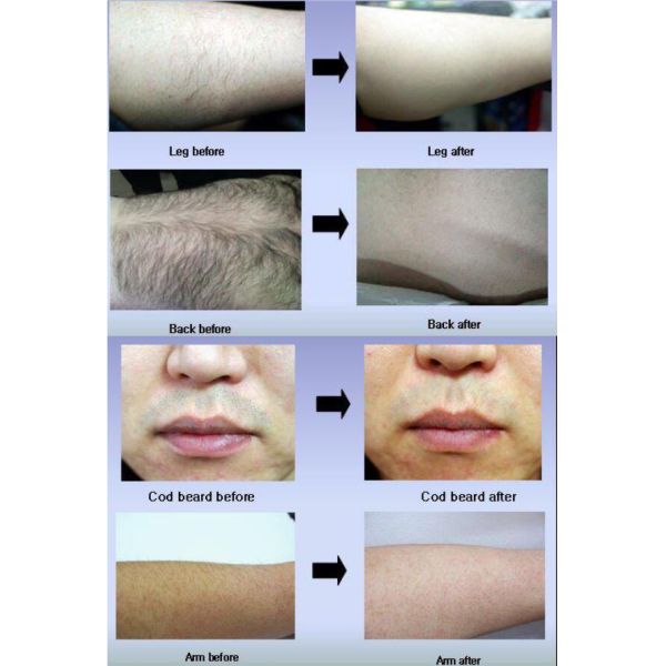 Trending hot products 808 diode laser hair removal beauty machine remove hair beauty equipment