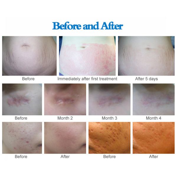 0-3.0mm Needle Length Adjustment Drs Dermaroller System For Scar Removal