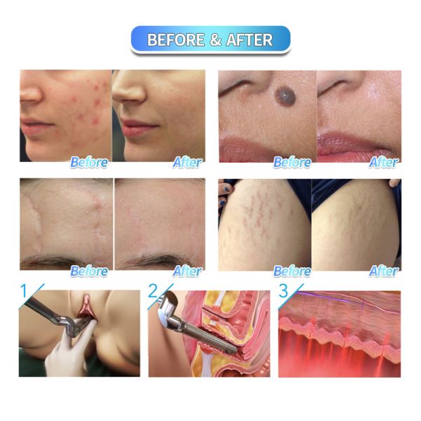 Fractional CO2 Laser Machine For Scar Removal Skin Resurfacing