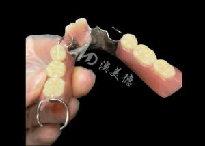 Cheap Titantium Cast Partial Dentures With Clasps Rests Along With Teeth Set Up for sale