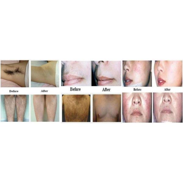 strong power painless portable 808nm diode laser hair removal device for salon use