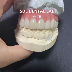 All On Four Six Ivoclar Zirconia Implant Bridge TItanium Bar With Pink Gum