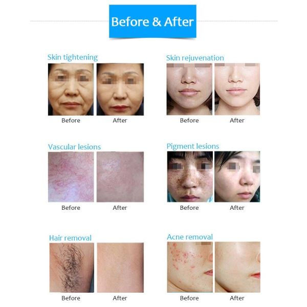 Super model new design 4 in 1 Nd Yag Tattoo Removal diode laser IPL skin rejuvenation beauty machine