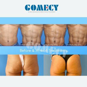 True Sculpting ID Dissolving Muscle Stimulator Ems Fat Reduce Machine Belly