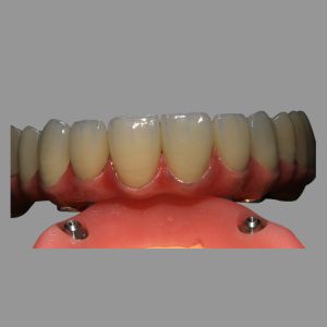 Class 2 Hybrid Malong Full Arch AOX Implant Bridge Titanium Bar with Full Solid