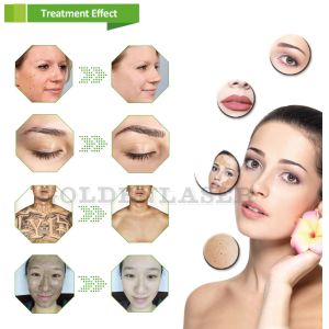 Experience Smooth and Hair-Free Skin with Diode Laser Hair Removal Machine