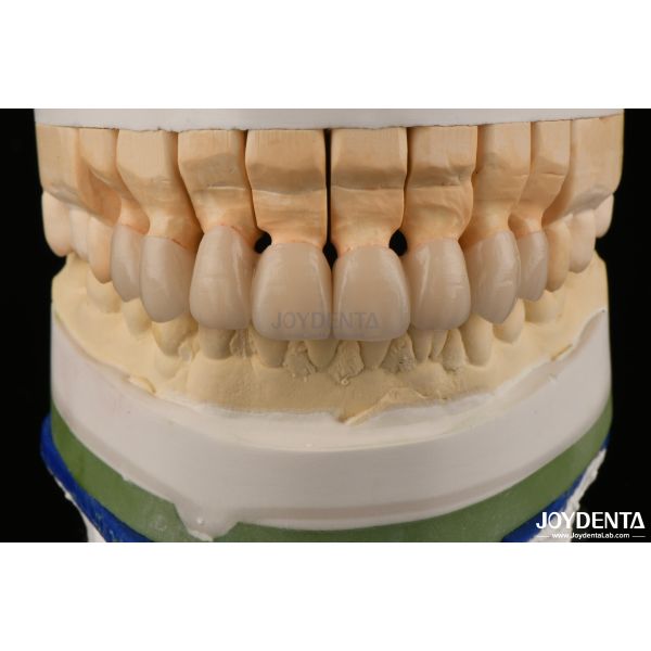 High Translucency Layered Zirconia Crowns Bridges Dental Restorations lifelike