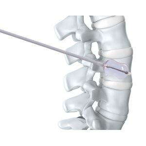 PKP Surgical Spine Kyphoplasty Instrument , Balloon Kyphoplasty Orthopedic