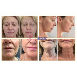 9D Hifu Focused Ultrasound Facial Smas Lifting Machine Anti-wrinkle Vmax Hifu 9d