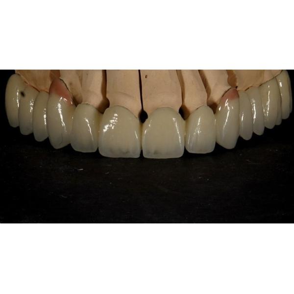 Good Fitting Good Esthetics Multi Layered Zirconia Crown Porcelain Zirconia