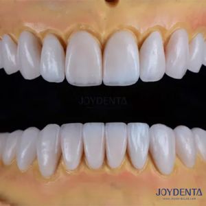 Custom Crafted Emax Porcelain Veneers Smooth Texture Dental Restorations