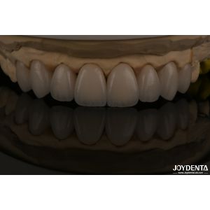 Feldspathic Natural Looking Cosmetic Veneers Precise Fit Highly Translucent