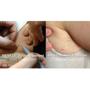 High Frequency Professional Vascular Removal Machine Spider Vein Removal Machine