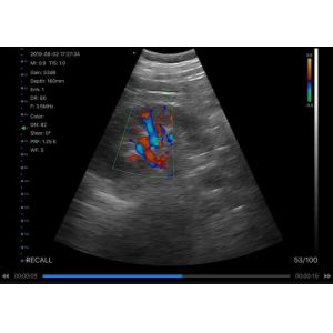 Pocket Handheld Ultrasound Scanner With Wifi Connected To IPad Mobilephone