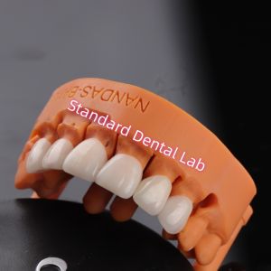 Comfort and Function with Digital CAD CAM Dental Lab Translucent Layered