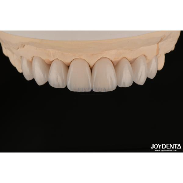 Quality Smooth And Lightweight Dental Veneers Biocompatible And Comfortable For Oral Health wholesale