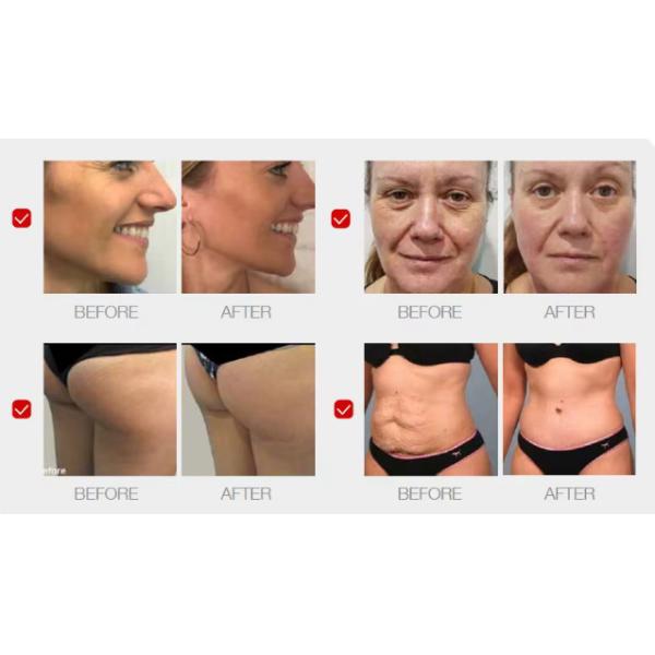 Professional 7D Hifu Eyes Wrinkles Removal Body Shaping Face Lifting MMFU Machine