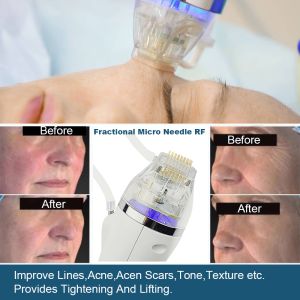 Radio Frequency Fractional And Micro Needling Rf Machine Gold Microneedling Skin