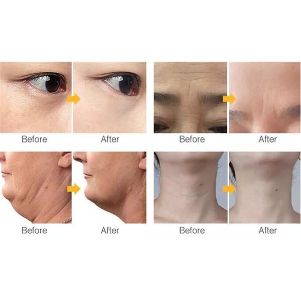 Handheld Hifu Rf Skin Tightening Machine Home Use Facial Lifting Device