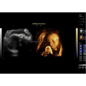 Ultrasound Imaging Machine Portable Ultrasound Scanner with 160G Capacity