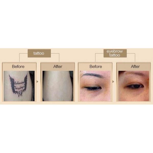 Picosecond q switched nd yag laser picosure q-switched tattoo removal laser machine