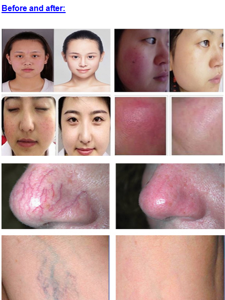 980nm Diode Laser beauty Machine For Vascular Lesions And Spider Veins