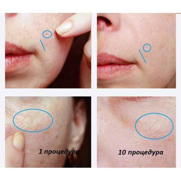 ZGTS 192 Titanium Micro Needle Derma Roller for Hair Loss Treatment anti-wrinkle dermaroller