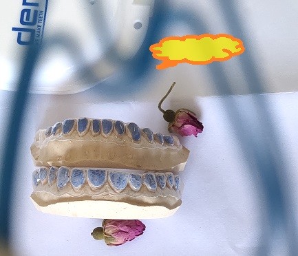 Quality Custom ISO13485 Bleaching Tray For Whitening Teeth wholesale