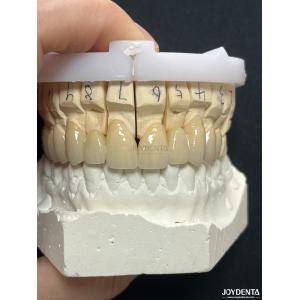 China Seamless PFM Porcelain Fused Metal Crown For Long Term Biocompatible Restoration on sale