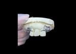 Easy Fit Custom Cast Partial Denture Stable and Natural-looking Framework for
