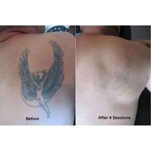 Color Screen 1064nm 532nm 1320nm advanced ND Yag Q Switch Laser blackhead