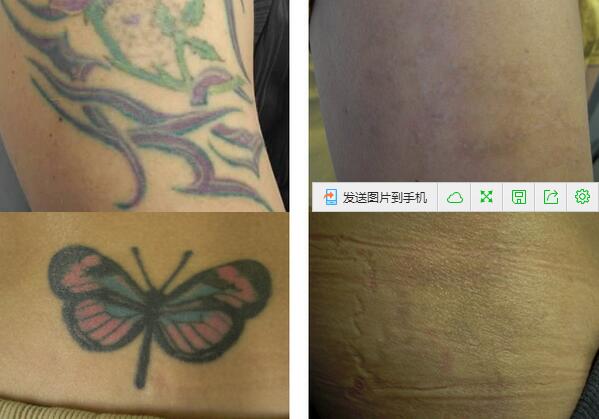 Q-switch ND YAG laser tattoo removal machine with high quality