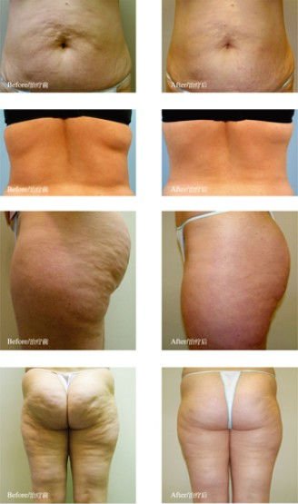 Lipo Vacuum Slimming Machine