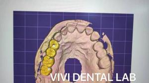 Cheap Full Contour Dental Crown Design Zirconia CE FDA Certified for sale